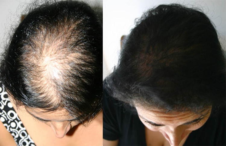 Hair Transplant in Chennai | hair loss treatment in chennai