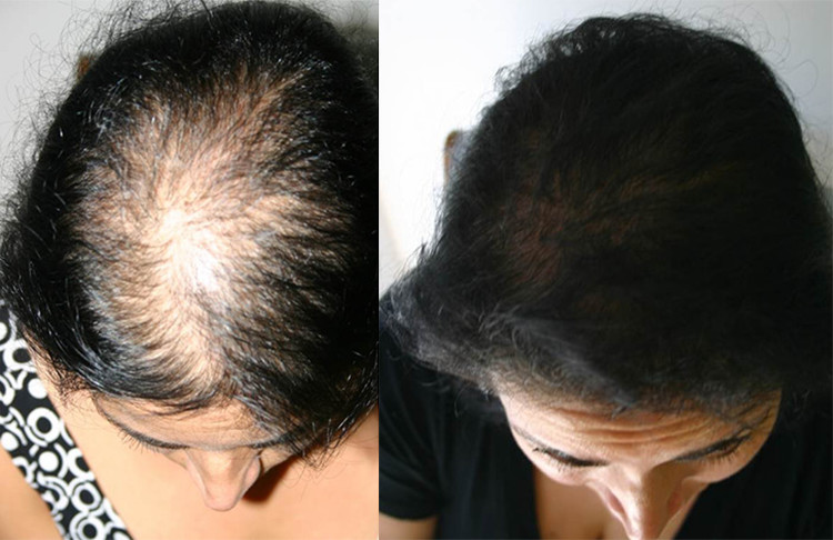 hair loss treatment in chennai