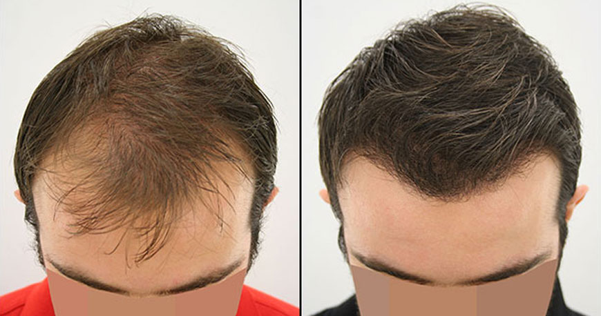 hair loss treatment in chennai