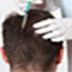 Doctors for Hair Loss Treatment in Chennai