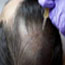 PRP Hair Treatment In Chennai